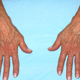 Imagen: Vein Experts